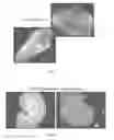 Fig. 10 - Cre-lox based gene knockdown constructs and methods of use thereof