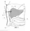 Fig. 02 - SURGICAL DEVICES FOR MANIPULATING TISSUE