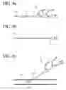 Fig. 05 - BLOOD FLOW BLOCKING CATHETER