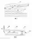 Fig. 02 - CATHETER FOR CELL DELIVERY