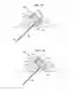 Fig. 09 - DISPOSABLE INFUSION DEVICE WITH LOCKED CANNULA