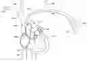 Fig. 01 - IMPLANTATION METHODS, SYSTEMS AND TOOLS FOR INTRAVASCULAR IMPLANTABLE DEVICES