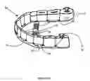 Fig. 02 - Custom instant flossing appliance