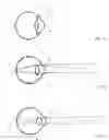 Fig. 02 - Vision modification with reflected image