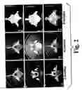 Fig. 03 - Highly mineralized osteogenic sponge compositions and uses thereof