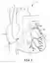 Fig. 02 - Guide catheters for accessing cardiac sites