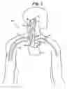 Fig. 02 - BAROREFLEX ACTIVATION FOR ARRHYTHMIA TREATMENT