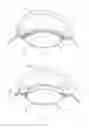 Fig. 06 - ACCOMMODATIVE INTRAOCULAR LENS SYSTEM