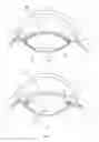 Fig. 07 - ACCOMMODATIVE INTRAOCULAR LENS SYSTEM
