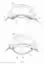 Fig. 08 - ACCOMMODATIVE INTRAOCULAR LENS SYSTEM