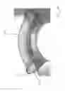 Fig. 02 - INSTRUMENT AND METHOD FOR THE ENDOSCOPICALLY CONTROLLED SHORTENING AND/OR FRAGMENTATION OF STENTS LOCATED IN HOLLOW ORGANS
