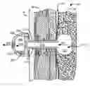 Fig. 01 - Pneumostoma management device and method for treatment of chronic obstructive pulmonary disease