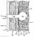 Fig. 01 - ACCELERATED TWO-PHASE SURGICAL PROCEDURE FOR CREATING A PNEUMOSTOMA TO TREAT CHRONIC OBSTRUCTIVE PULMONARY DISEASE