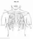 Fig. 02 - ACCELERATED TWO-PHASE SURGICAL PROCEDURE FOR CREATING A PNEUMOSTOMA TO TREAT CHRONIC OBSTRUCTIVE PULMONARY DISEASE