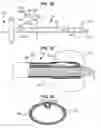 Fig. 06 - ACCELERATED TWO-PHASE SURGICAL PROCEDURE FOR CREATING A PNEUMOSTOMA TO TREAT CHRONIC OBSTRUCTIVE PULMONARY DISEASE