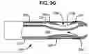 Fig. 07 - ACCELERATED TWO-PHASE SURGICAL PROCEDURE FOR CREATING A PNEUMOSTOMA TO TREAT CHRONIC OBSTRUCTIVE PULMONARY DISEASE