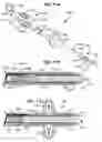 Fig. 28 - ACCELERATED TWO-PHASE SURGICAL PROCEDURE FOR CREATING A PNEUMOSTOMA TO TREAT CHRONIC OBSTRUCTIVE PULMONARY DISEASE