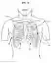 Fig. 02 - Surgical instruments for creating a pneumostoma and treating chronic obstructive pulmonary disease