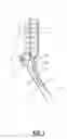 Fig. 02 - Micro-Flail Assembly And Method Of Use For The Preparation Of A Nucleus/Vertebral End Cap Of A Spine