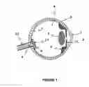 Fig. 02 - Apparatus and method for preventing glaucomatous optic neuropathy