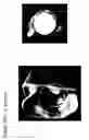 Fig. 12 - Earpiece sealing system