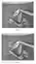Fig. 06 - Devices and Methods for Placing Slings and Other Materials