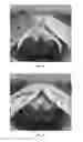 Fig. 08 - Devices and Methods for Placing Slings and Other Materials