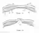 Fig. 02 - Methods and apparatus for treating ventral wall hernia