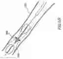 Fig. 09 - Device and method for treating a vessel