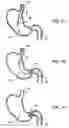 Fig. 09 - Gastric retaining devices and methods