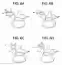 Fig. 06 - Methods for correction of spinal deformities