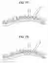 Fig. 08 - Methods for correction of spinal deformities
