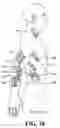 Fig. 09 - SELF-CONTAINED ELECTRONIC MUSCULOSKELETAL STIMULATION APPARATUS AND METHOD OF USE
