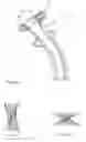 Fig. 04 - GASTRIC BYPASS PROSTHESIS FIXATION SYSTEM AND METHOD FOR TREATMENT OF OBESITY