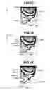 Fig. 10 - Medical image processing apparatus and method for detecting locally protruding lesion