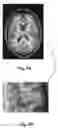 Fig. 12 - Method and apparatus for registration of an atlas to an image