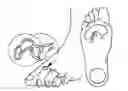 Fig. 01 - Electrosurgical method and system for treating foot ulcer