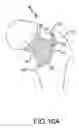 Fig. 35 - Hip resurfacing surgical guide tool
