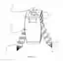 Fig. 04 - Posterior cervical and lumbar interarticulating joint staples, stapling guns, and devices for spinal fusion