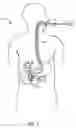 Fig. 02 - Anastomotic device