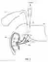 Fig. 03 - Anastomotic device