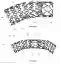 Fig. 16 - STENT EXPANSION COLUMN, STRUT AND CONNECTOR SLIT DESIGN