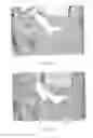 Fig. 06 - Compression stocking applicator