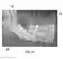 Fig. 15 - Compression stocking applicator