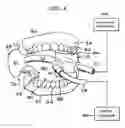Fig. 02 - Intraoral device