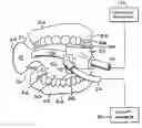 Fig. 01 - Intraoral device