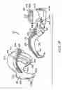 Fig. 03 - Intraoral device
