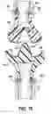 Fig. 09 - Reinforced joint assembly