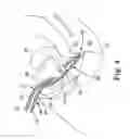Fig. 04 - Adjustable Sling and Method of Treating Pelvic Conditions
