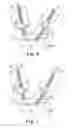 Fig. 05 - Adjustable Sling and Method of Treating Pelvic Conditions